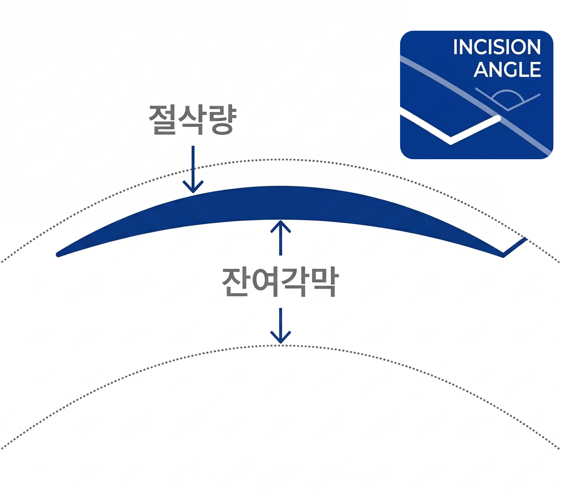 5세대 시력교정